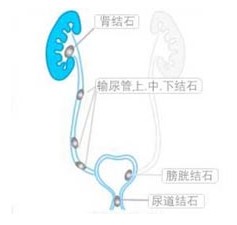 結石終結者——鈥激光